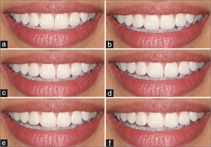 Teeth midline shift