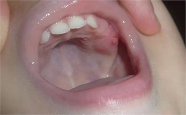 What happens if a part of baby tooth is left in the gum?