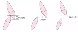 Malocclusion - difference between overbite, overjet and open bite