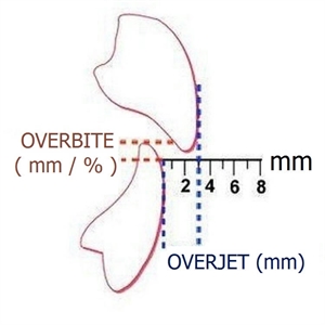 This is the difference between overjet and overbite