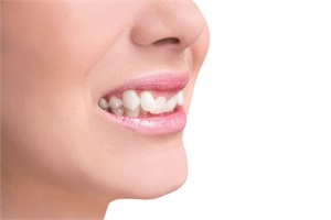 Overbite is a vertical overlapping of the front teeth