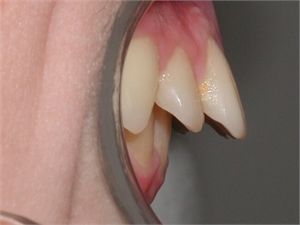 Overjet is a horizontal overlapping of the anterior teeth