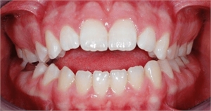 Open bite is a dental condition in which the patient has no contact on the anterior teeth. Back teeth, however, are in occlusion.