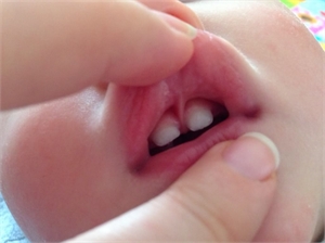 Upper lip tie causing space between upper incisors - diastema.