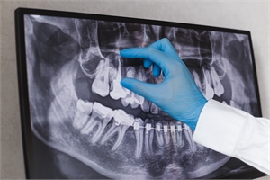 The dental x-ray shown on this picture is called by several names - OPG, full mouth x-ray or Panoral