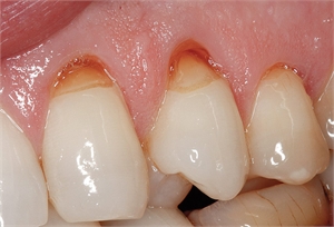 V-shaped tooth wear caused by excessive brushing