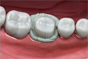 Gingival Retraction Paste retracts the gum margins and stops the bleeding from the tooth sulcus
