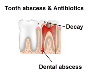Will a tooth abscess go away with antibiotics?