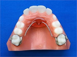 Orthodontic appliance Nance Palatal Arch