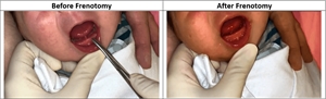 Frenetomy is slight adjustment (shortening) of the frenulum by snipping it off