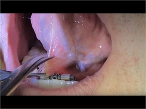 Frenuloplasty is adjusting the frenulum at the attachment point