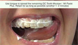 Application of Tooth Mousse gel in patient mouth