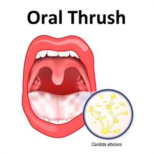 The ultimate guide to treating oral thrush