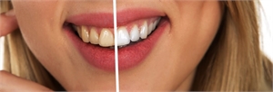 Learn How To Make Your Smile White And Bright Fast