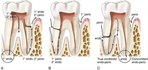 Perio Endo lesion leads to the inflammation of both periodontium and endodontium