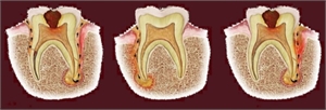 Inflammation which covers the inside of the tooth along with the periodontal tissues is known as endo-perio lesion