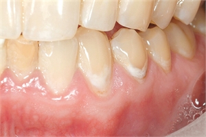 What is incipient caries?