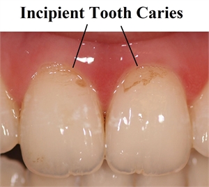 Incipient tooth caries on the buccal surface of incisor tooth