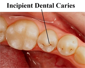 Incipient dental caries in the occlusal fissure of tooth
