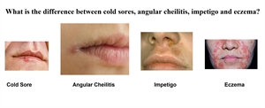 What is the difference between angular cheilitis, impetigo, eczema and cold sores?