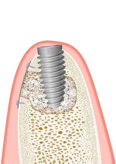 Facts About Dental Implant Recovery Process