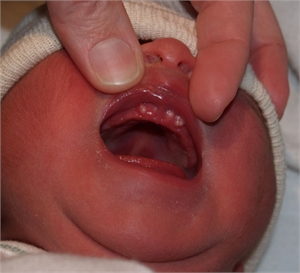 Baby natal teeth (baby born with teeth) 
