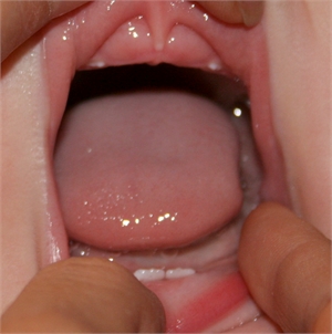 Neo-natal teeth are early deciduous teeth that come in during the first month of life.