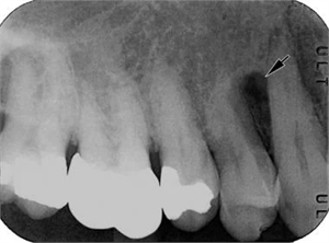 What is lateral periodontal cyst?
