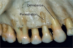 What is the difference between dental dehiscence and fenestration?