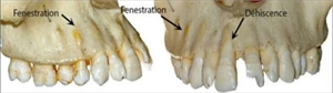 Difference between dental fenestration and dental dehiscence
