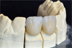 What is pressed ceramic dental crown?