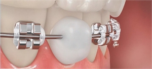The orthodontic wax is applied on the top of the bracket or wide edge in order to avoid friction between the metal and the soft tissues of the mouth.