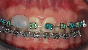 Orthodontic wax applied on the bracket and protecting soft tissues.
