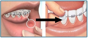 How to Use Orthodontic Wax