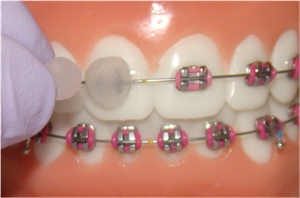 Placing orthodontic/dental wax over brackets