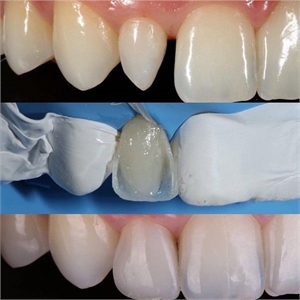 Peg tooth treatment. Composite build-up for a pegged tooth
