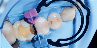 What is sectional matrix in dentistry?