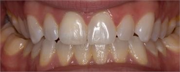 What is posterior crossbite?