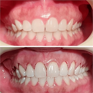 Gingivoplasty reshapes and recontours healthy gum tissues to make it aesthetically pleasing.
