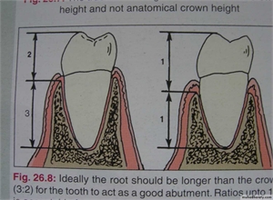 Crown to root ratio in height