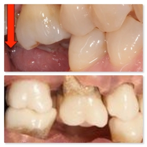 Overeruption of molar teeth