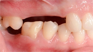 Teeth overeruption