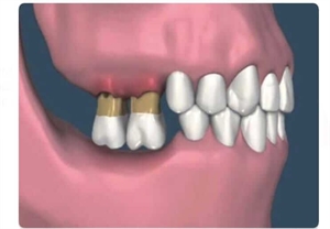 Overeruption of teeth