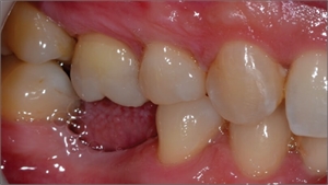 Overerupted upper molar tooth. Overeruption appears when the opposing tooth is missing
