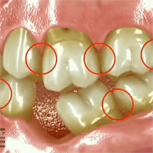 Teeth shifting into a gap caused by a missing tooth