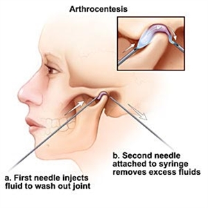 What is TMJ Arthrocentesis?