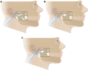 Arthrocentesis of TMJ (temporomandibular joint)