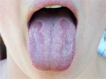 Tongue thrush