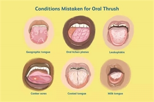 Tongue thrush differential diagnosis - what other oral conditions can oral thrush be mistaken for