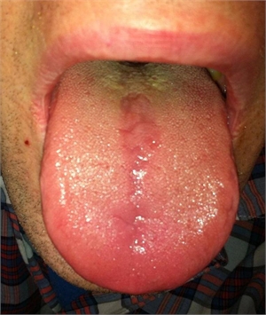 Thrush on tongue - oral thrush